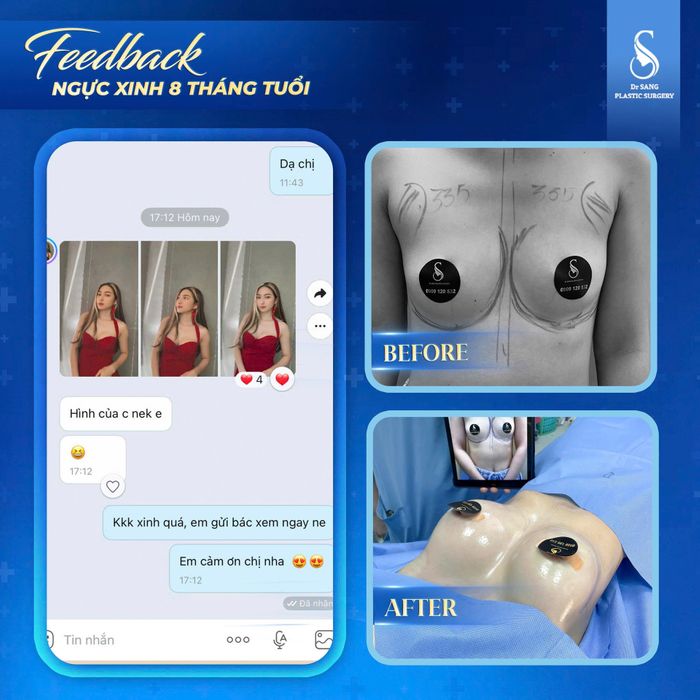 Cấy mỡ tạo dáng đồng hồ cát